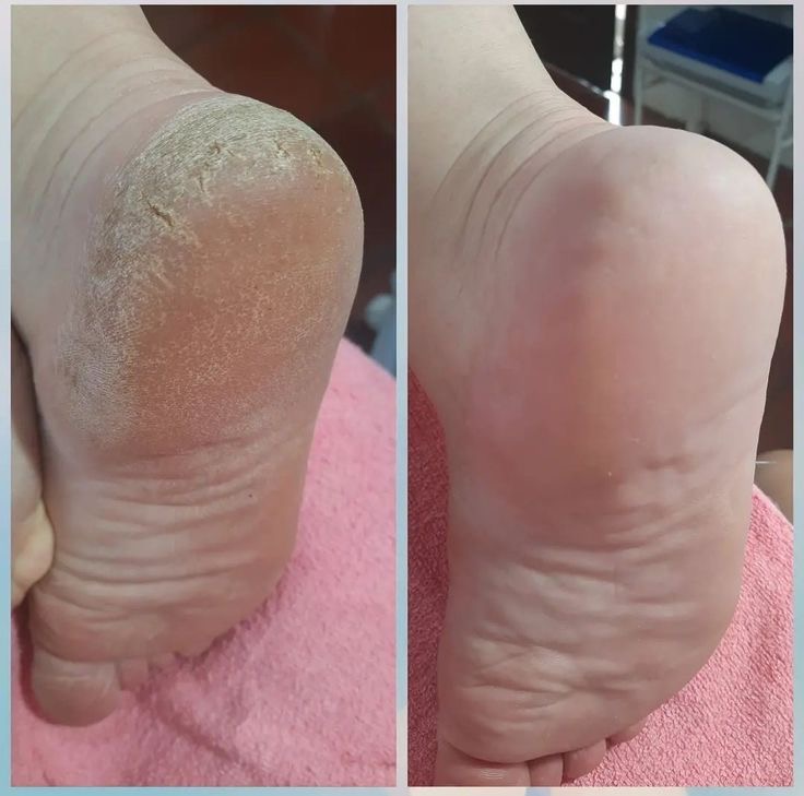 اسپری رفع ترک پا راکو (حجم ۱۵۰ میل)